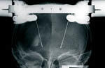 Röntgenbild mit angelegtem Stereotaxiering und implantierten Elektroden