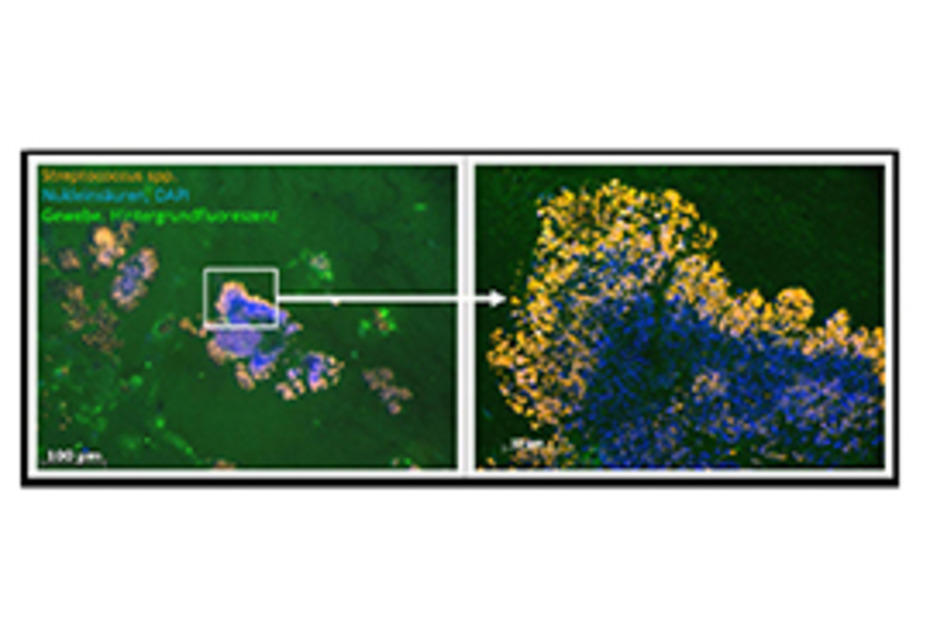 Streptokokken Biofilm auf einer menschlichen Herzklappe