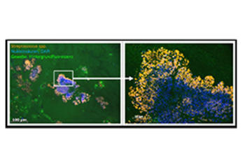 Streptokokken Biofilm auf einer menschlichen Herzklappe